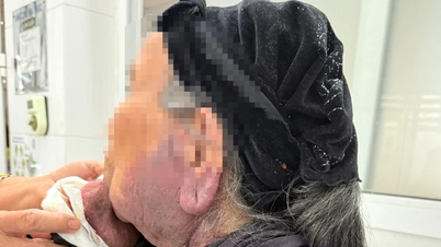 ہونٹ کے علاقے میں ایک بڑے نیکروٹک ہیمنگیوما کو دور کرنے کے لیے سرجری