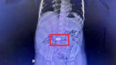 Khanh Hoa: Dalam satu bulan, rumah sakit menerima 5 anak yang menelan koin.