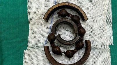 医師がのこぎりで銀の指輪を切り、閉じ込められた「小さな男の子」を救出