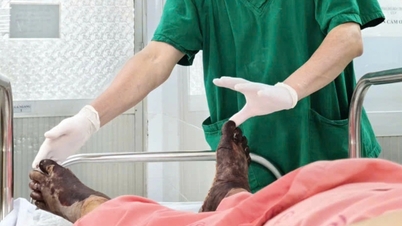 "Uyuşukluğu gidermek" amacıyla ayakları sıcak tuzlu suya batırmak, birçok diyabet hastasının bacaklarının ampute edilmesine yol açmıştır.