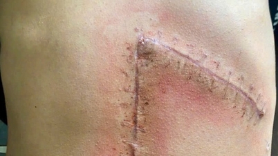 Adolescent salvat de la șocul hemoragic cauzat de o ruptură splenică de gradul 5 în urma unui accident rutier.