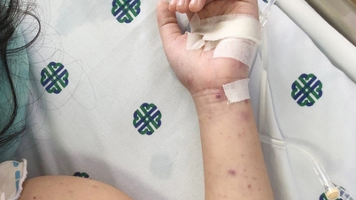Egyre több a meningococcus okozta agyhártyagyulladás; kinek kell óvatosnak lennie?