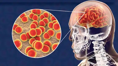 Gia tăng ca bệnh não mô cầu, thể tối cấp có thể tử vong trong 24 giờ