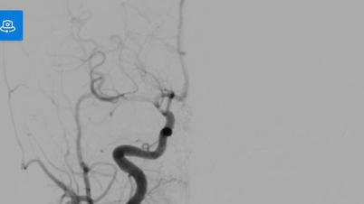 Amaran strok pada kanak-kanak: Kes membangkitkan subjektiviti