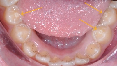 Зубы с дополнительными бугорками — риск осложнений, если не лечить вовремя