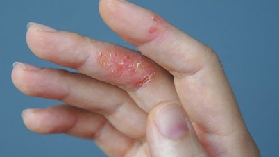 Neurodermitis verschlimmert sich bei kaltem, trockenem Wetter.