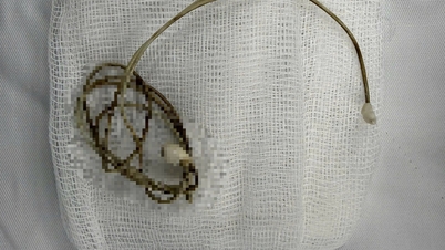 និស្សិត​ប្រុស​ត្រូវ​វះកាត់​សង្គ្រោះ​បន្ទាន់ ដោយសារ​ឆ្នាំង​សាក​ទូរស័ព្ទ​ក្នុង​ប្លោកនោម ក្រោយ​ពី​ធ្វើ​ត្រាប់​តាម​ឃ្លីប​អនឡាញ។