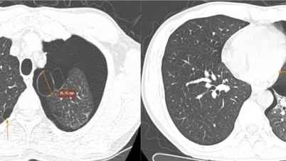 Penyelamatan tepat waktu bagi seorang pria dengan pneumotoraks parah akibat pecahnya kantung udara
