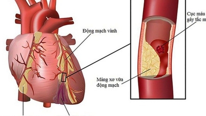 5 biện pháp giảm nguy cơ biến cố tim mạch khi thời tiết lạnh