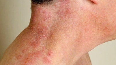 Gründe, warum ältere Menschen anfällig für Gürtelrose sind