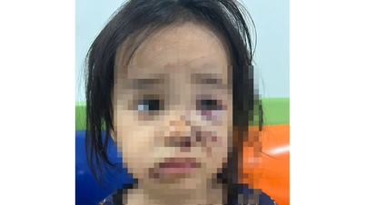 आवारा कुत्ते के हमले के बाद 4 साल की बच्ची अस्पताल में भर्ती