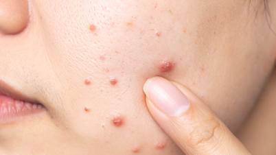 A causa da acne na menopausa