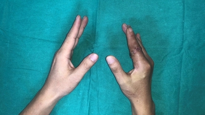 Pela primeira vez no Vietnã, um dedo decepado após 25 horas foi reimplantado com sucesso.