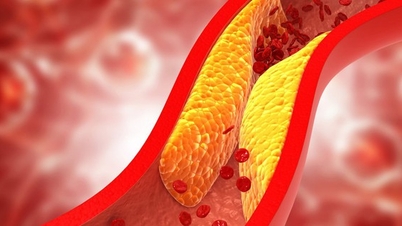 5 порад, які допоможуть запобігти високому холестерину та інсульту