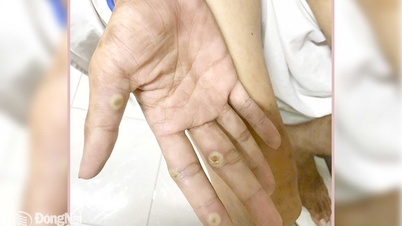 트랑봄에서 원숭이두창의 첫 번째 사례가 발견되었지만, 감염원은 알려지지 않았습니다.