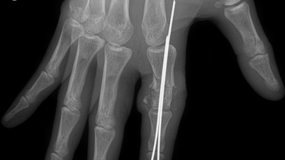 선원의 잘린 손가락, 25시간 만에 구조돼
