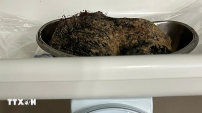 Операція з видалення 500 грамів волосся зі шлунка 6-річного пацієнта