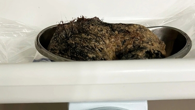 Bé gái 6 tuổi ăn nửa cân tóc