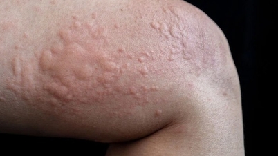 Penyebab umum gatal-gatal adalah rasa gatal dan tidak nyaman