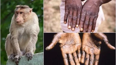 В Донгнае зарегистрирован 1 случай оспы обезьян.