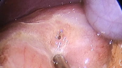 Notoperation bei einem 13-jährigen Patienten mit einem perforierten Magengeschwür und eine Warnung des Arztes