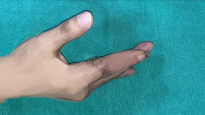 Po raz pierwszy mikrochirurgia skutecznie uratowała życie marynarzowi, którego palec został odcięty po 25 godzinach.