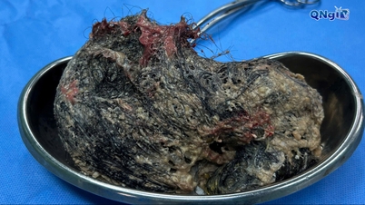 Het verwijderen van een haarbal van 0,5 kg uit de maag van een kind