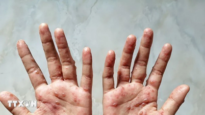 ডং নাইতে প্রথম মাঙ্কিপক্সের ঘটনা রেকর্ড, নিয়ন্ত্রণ জোরদার এবং সংক্রমণের উৎস খুঁজে বের করা হয়েছে