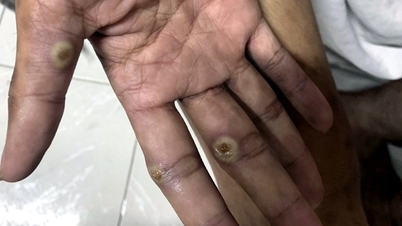 डोंग नाई प्रांत में मंकीपॉक्स का एक मामला सामने आया है, जिसके संक्रमण का स्रोत अज्ञात है; स्वास्थ्य अधिकारी संक्रमण के स्रोत का पता लगाने के लिए तत्काल प्रयास कर रहे हैं।