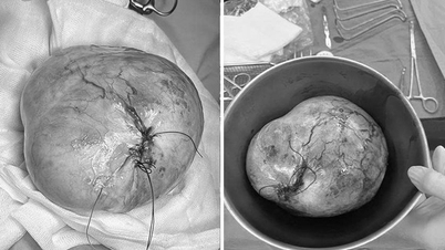 Phenikaa sikeresen műtétet hajtott végre egy 9 éves kislányon, akinek 20 cm-es petefészek teratómája volt, megőrizve a termékenységét.