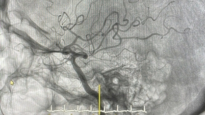 ເສັ້ນເລືອດຕັນໃນເກືອບເຮັດໃຫ້ແມ່ຍິງຜູ້ສູງອາຍຸສູນເສຍຈຸລັງສະຫມອງຫຼາຍລ້ານຕໍ່ນາທີ.