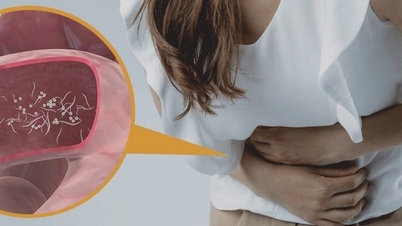 Wurmbefall im Dickdarm einer Frau, die regelmäßig rohes Gemüse isst.