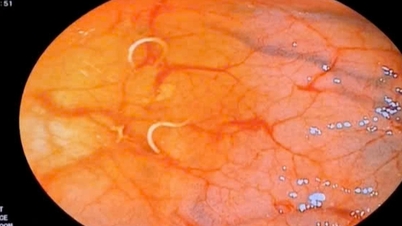 Een gerecht waar veel mensen dol op zijn, maar dat bij de vrouw uiteindelijk wormen in haar maag veroorzaakte.