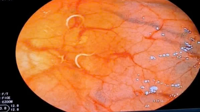 เนื่องจากมีอาการผิดปกติของระบบย่อยอาหารเรื้อรัง ผู้ป่วยจึงตรวจพบว่าตนเองติดเชื้อพยาธิแส้อย่างรุนแรงโดยไม่คาดคิด