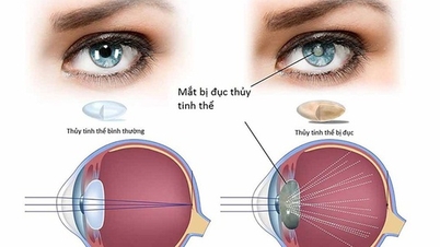 백내장의 일반적인 징후 및 증상