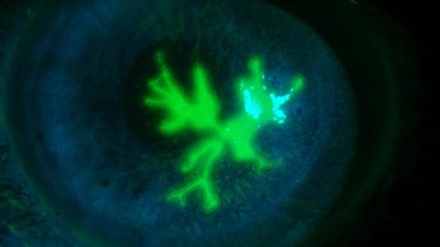 চোখ ঘষার অভ্যাসের কারণে কর্নিয়ায় "গাছের ডাল" আবিষ্কার করেন এক মহিলা, প্রায় অন্ধ হয়ে যান।