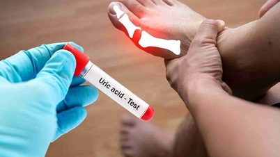 5 féle ital, amit éhgyomorra érdemes fogyasztani, hogy csökkentse a magas húgysavszintet.