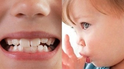 Tratamento precoce da mordida cruzada anterior em dentes decíduos de crianças.