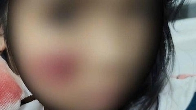 Ville aper angriper små barn og forårsaker komplekse skader i ansiktet og hodet.