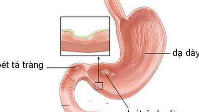 5 häufige Komplikationen von Magenkrebs, über die Sie Bescheid wissen sollten.