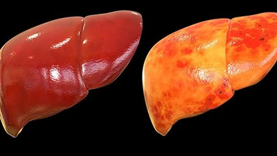 Approximately 10-20% of thin people suffer from fatty liver disease.