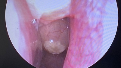 Successful surgery for a patient with bilateral nasal polyps, rhinosinusitis, and a range of severe underlying conditions.