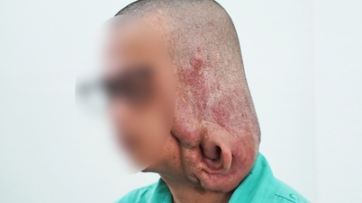 A giant neurofibroma weighing nearly 1 kg was surgically removed, restoring the young man's appearance.