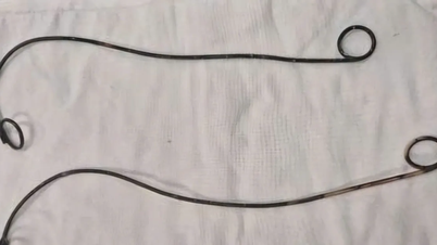 Operasi untuk mengangkat dua stent JJ ​​yang tertinggal di dalam tubuh pasien selama lebih dari 10 tahun.