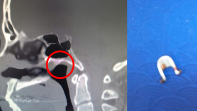 Man suffers from headaches for 40 years due to a foreign object 'left' deep in his nose.