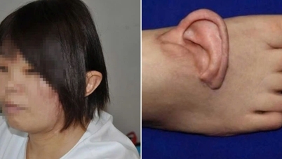 Ca phẫu thuật chưa từng có trên thế giới: Ghép tai bị đứt lên bàn chân rồi đưa về chỗ cũ