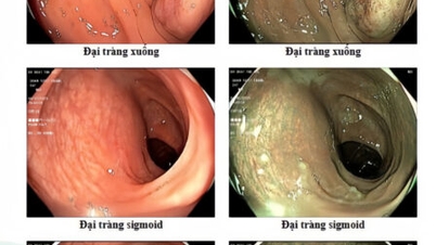 Ung thư đại tràng có thể xuất hiện ở người trẻ tuổi không?