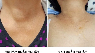 59-year-old woman detects thyroid tumor from signs that many Vietnamese people ignore
