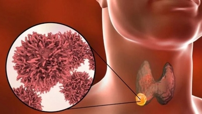 Dry cough, difficulty swallowing, rare cancer detected