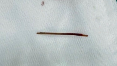 Phát hiện cây tăm dài 5 cm ghim trong gan bệnh nhân